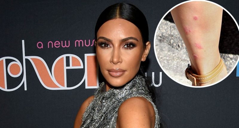 Kim Kardashian Psoriasis Pictures: Photos of Skin Breakouts